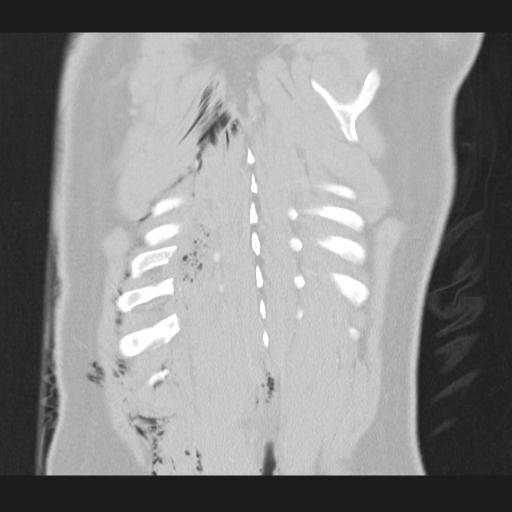 Bilateral traumatic renovascular injury (Radiopaedia 32051-32995 Coronal lung window 73).jpg
