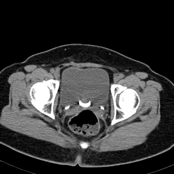 Bilateral ureteric stents (Radiopaedia 48795-53825 Axial non-contrast 63).jpg