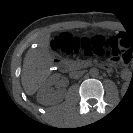 Bile leak from liver traumatic laceration (Radiopaedia 63463-72077 Axial Biliscopin 61).jpg