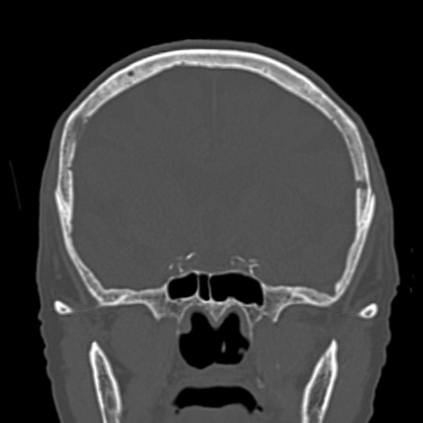 Biparietal osteodystrophy (Radiopaedia 46109-50463 Coronal bone window 45).jpg