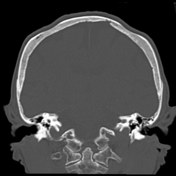 Biparietal osteodystrophy (Radiopaedia 46109-50463 Coronal bone window 62).jpg