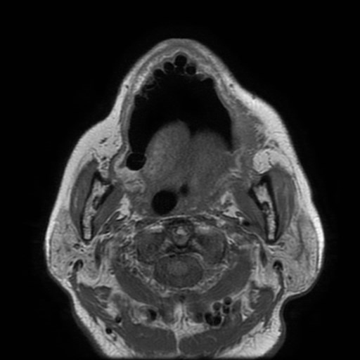 Bisphosphonate-related osteonecrosis of the maxilla (Radiopaedia 51367-57101 Axial T1 17).jpg