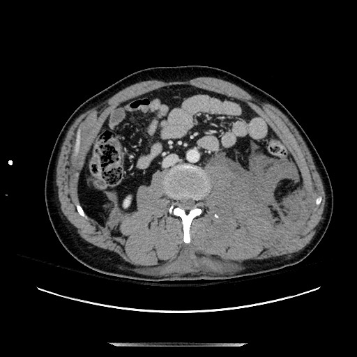 Blunt abdominal trauma with solid organ and musculoskelatal injury with active extravasation (Radiopaedia 68364-77895 A 77).jpg
