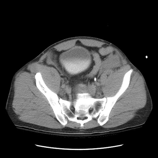 Blunt abdominal trauma with solid organ and musculoskelatal injury with active extravasation (Radiopaedia 68364-77895 Axial C+ delayed 110).jpg