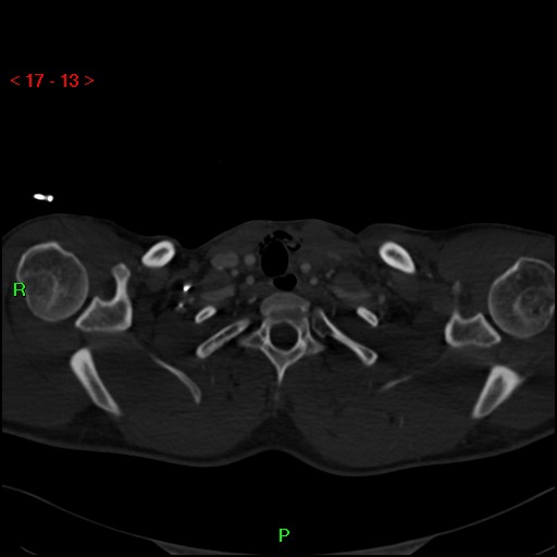 Blunt thoracic trauma (Radiopaedia 73454-84221 Axial bone window 5).jpg
