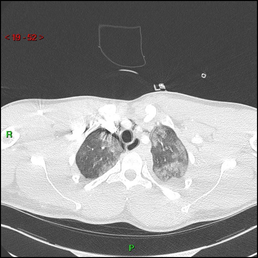 Blunt thoracic trauma (Radiopaedia 73454-84221 Axial lung window 19).jpg