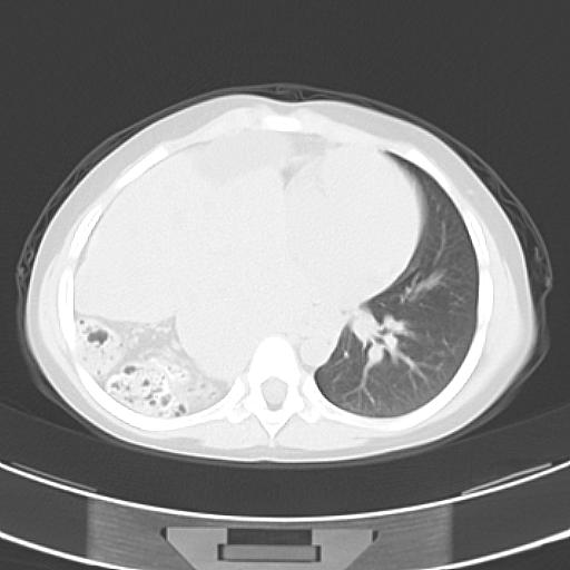 File:Bochdalek diaphragmatic hernia (Radiopaedia 38866-41059 Axial lung window 15).jpg