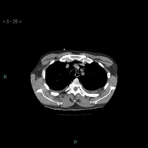 Boerhaave syndrome (Radiopaedia 27683-27897 Axial non-contrast 25).jpg