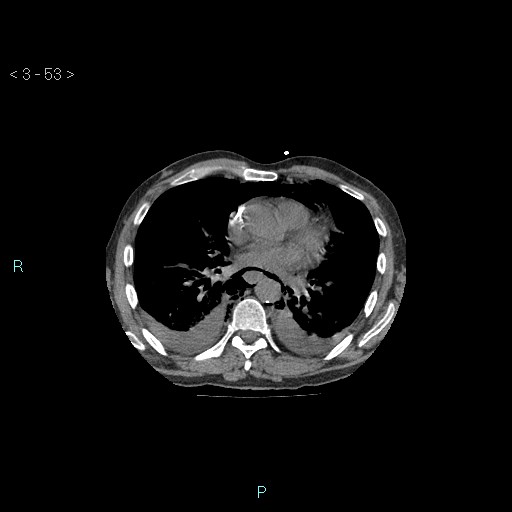 Boerhaave syndrome (Radiopaedia 27683-27897 Axial non-contrast 53).jpg