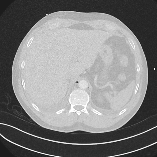 File:Boerhaave syndrome (Radiopaedia 39382-41660 Axial lung window 54).png