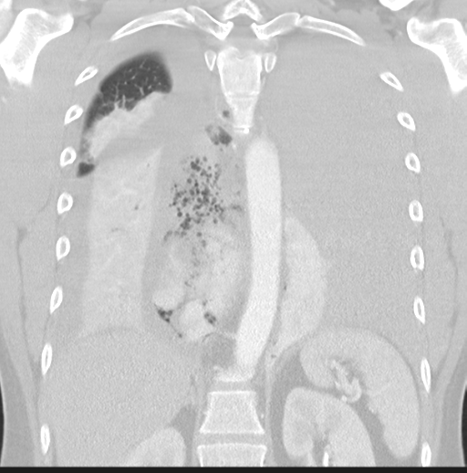 Boerhaave syndrome (Radiopaedia 39382-41661 Coronal lung window 34).png