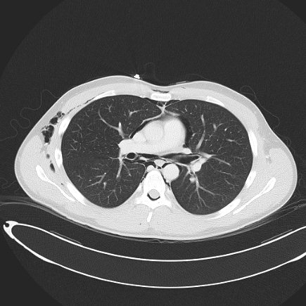 Boerhaave syndrome with mediastinal, axillary, neck and epidural free gas (Radiopaedia 41297-44115 Axial lung window 49).jpg