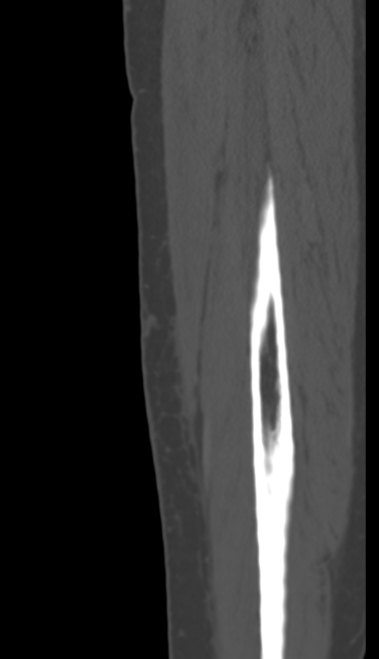 Bone metastasis - tibia (Radiopaedia 57665-64609 Sagittal bone window 163).jpg