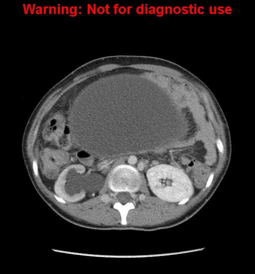 Borderline mucinous cystadenoma of ovary (Radiopaedia 25586-25767 A 11).jpg