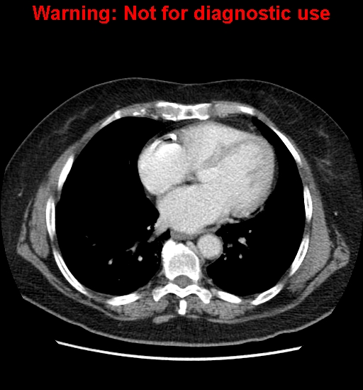 File:Bosniak renal cyst - type II (Radiopaedia 23404-23468 D 4).jpg