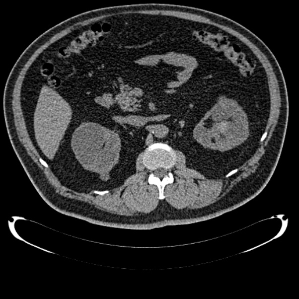 File:Bosniak renal cyst - type IV (Radiopaedia 24244-24518 Axial non-contrast 139).jpg