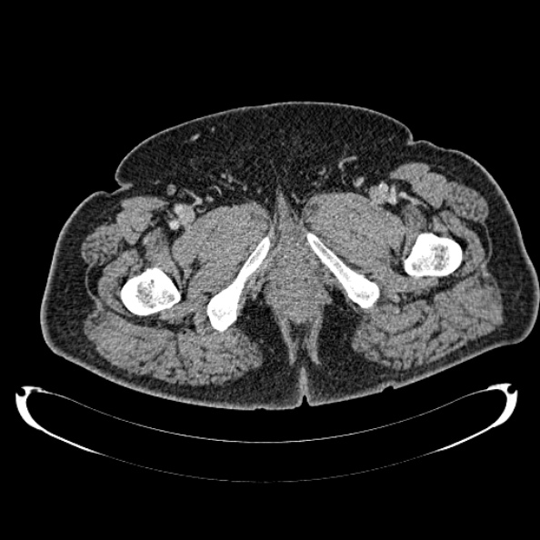 Bosniak renal cyst - type IV (Radiopaedia 24244-24518 C 338).jpg