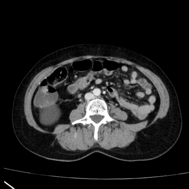 Bosniak renal cyst - type I (Radiopaedia 27479-27675 C 52).jpg