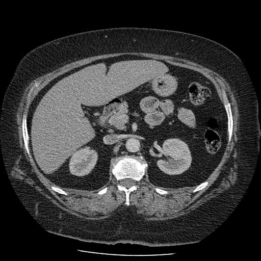 Bovine aortic arch - right internal mammary vein drains into the superior vena cava (Radiopaedia 63296-71875 A 203).jpg