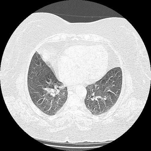 Bovine aortic arch - right internal mammary vein drains into the superior vena cava (Radiopaedia 63296-71875 Axial lung window 107).jpg