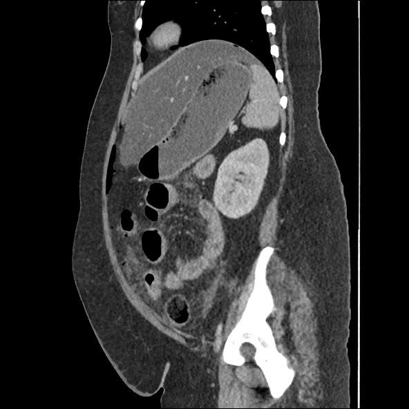 Bowel and splenic infarcts in acute lymphocytic leukemia (Radiopaedia 61055-68915 C 23).jpg