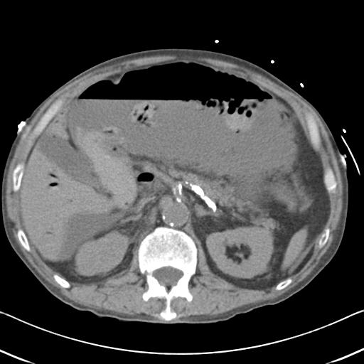 Bowel infarction (Radiopaedia 30296-30933 Axial non-contrast 24).jpg
