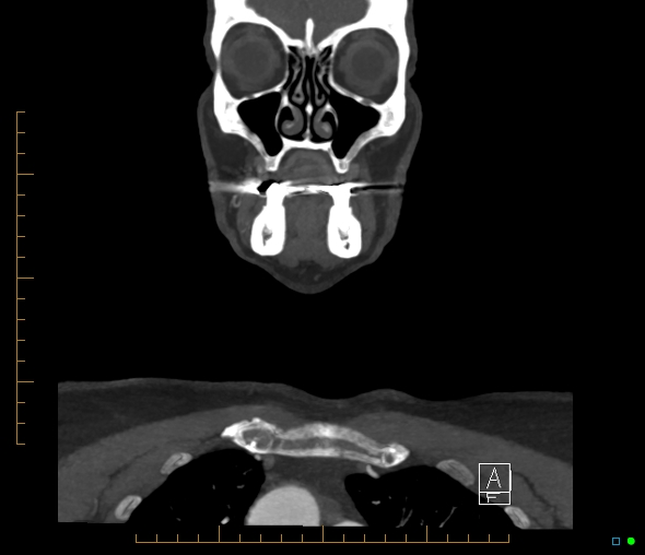 Brachiocephalic trunk stenosis (Radiopaedia 87242-103519 B 10).jpg