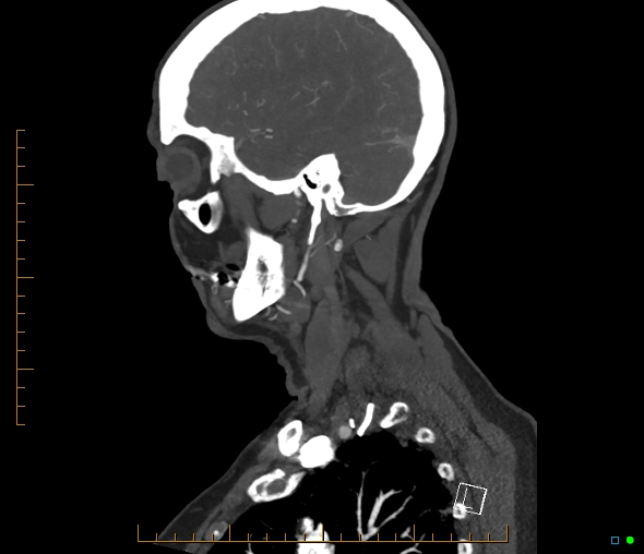 Brachiocephalic trunk stenosis (Radiopaedia 87242-103519 C 51).jpg