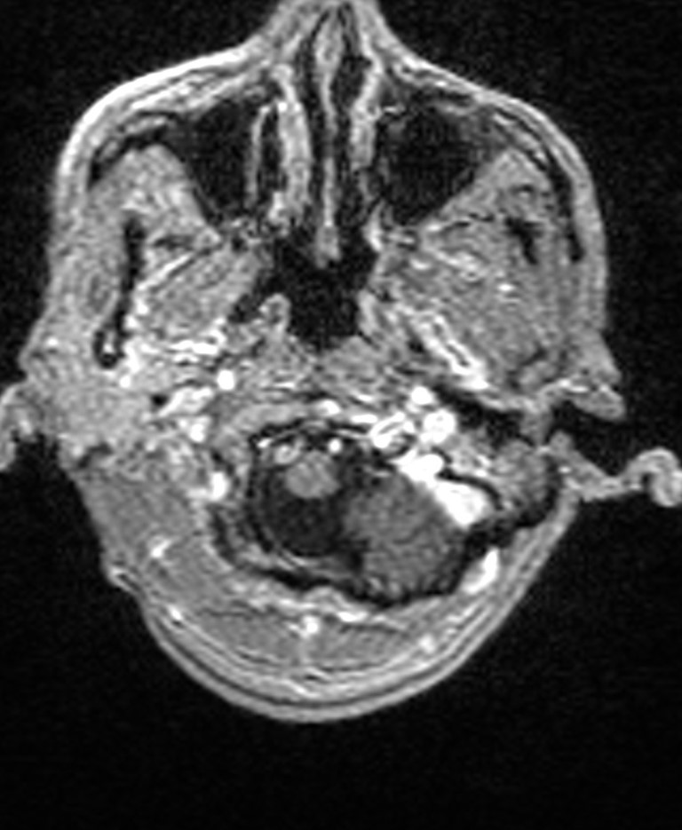 Brain abscess with dual rim sign (Radiopaedia 87566-103938 Axial T1 C+ 23).jpg