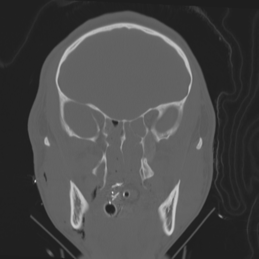File:Brain contusions, internal carotid artery dissection and base of skull fracture (Radiopaedia 34089-35339 Coronal bone window 27).png