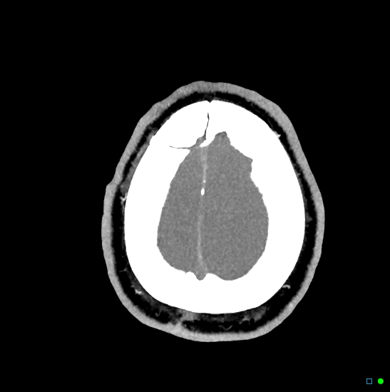 Brain death on MRI and CT angiography (Radiopaedia 42560-45841 B 7).jpg