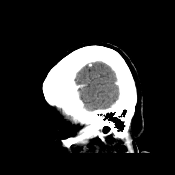 File:Brain metastases from breast cancer (Radiopaedia 23178-23231 C 42).jpg