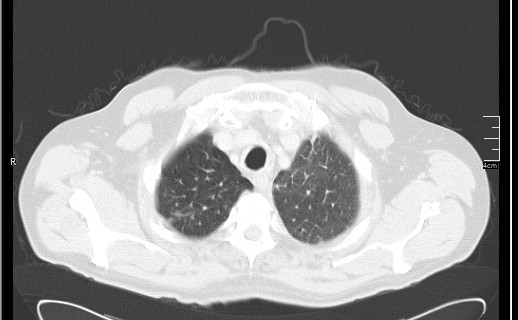Brain metastases from squamocellular lung cancer (Radiopaedia 56515-63219 Axial lung window 15).jpg