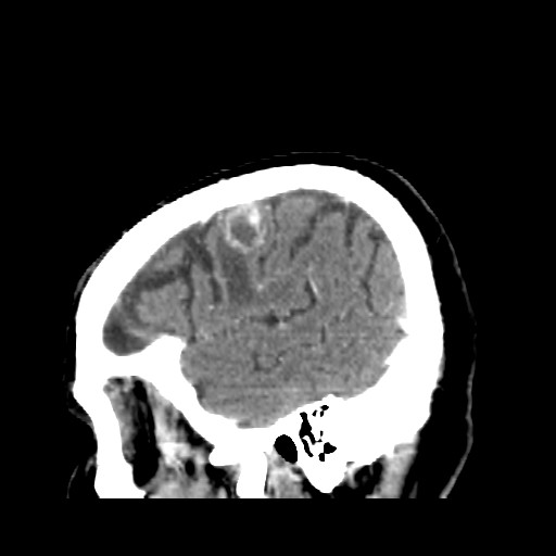 Brain metastasis (Radiopaedia 42617-45760 D 49).jpg