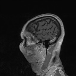 Brain metastasis (Radiopaedia 42617-45761 Sagittal T1 C+ 85).jpg