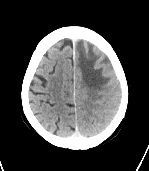 File:Brain metastasis (lung cancer) (Radiopaedia 48289-53177 Axial non-contrast 26).png