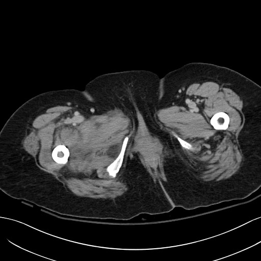Breast carcinoma with pathological hip fracture (Radiopaedia 60314-67974 B 80).jpg