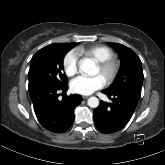 File:Breast metastases from renal cell cancer (Radiopaedia 79220-92225 A 54).jpg