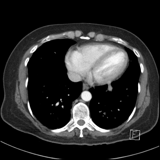 Breast metastases from renal cell cancer (Radiopaedia 79220-92225 A 67).jpg