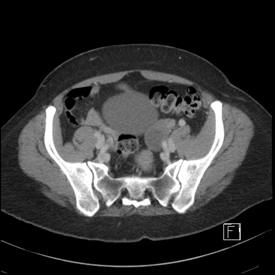 Breast metastases from renal cell cancer (Radiopaedia 79220-92225 C 89).jpg