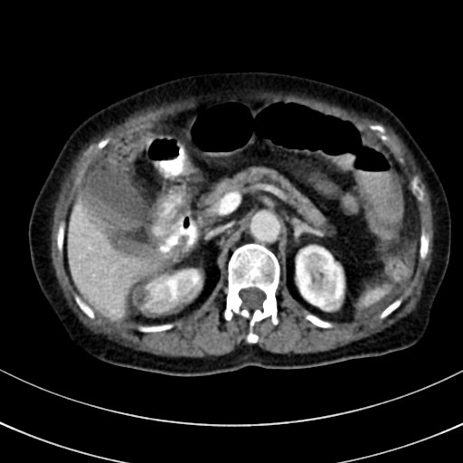 File:Broad ligament hernia (Radiopaedia 84802-100276 A 140).jpg