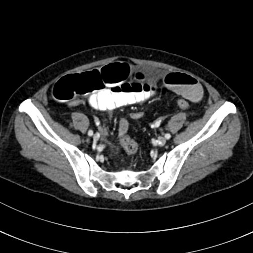 File:Broad ligament hernia (Radiopaedia 84802-100276 A 53).jpg
