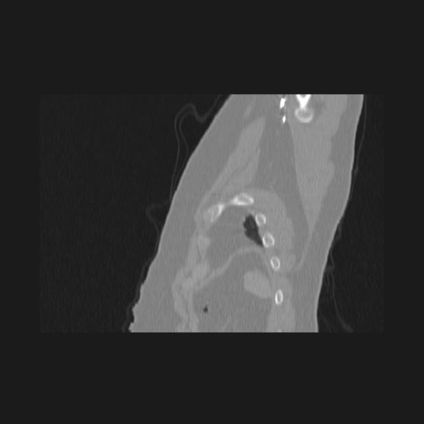 Bronchial atresia (Radiopaedia 60685-68439 Sagittal lung window 94).jpg