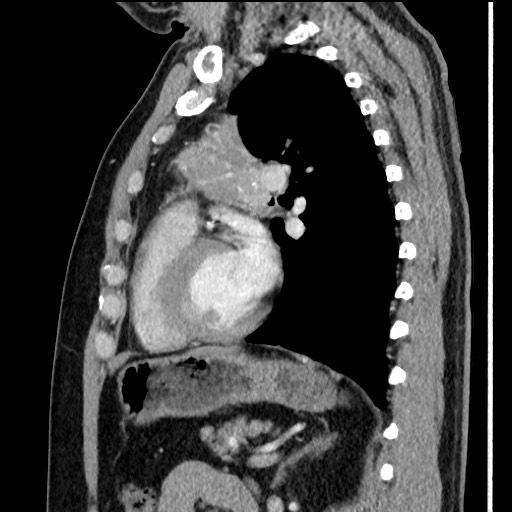 Bronchial carcinoid tumor (Radiopaedia 67377-76764 E 44).jpg