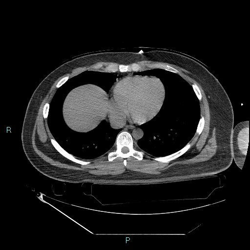 Bronchial carcinoid tumor (Radiopaedia 78272-90870 Axial non-contrast 73).jpg