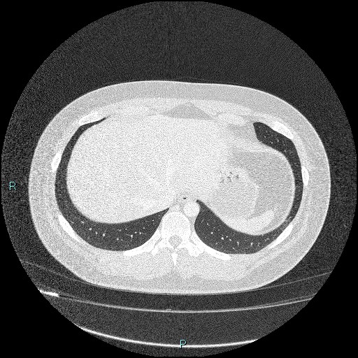 Bronchial carcinoid tumor (Radiopaedia 78272-90875 Axial lung window 45).jpg