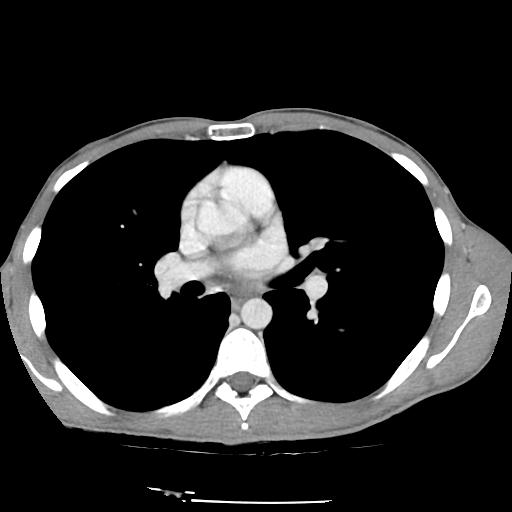 Bronchial carcinoid tumor causing right lower lobe collapse (Radiopaedia 83495-98594 A 24).jpg