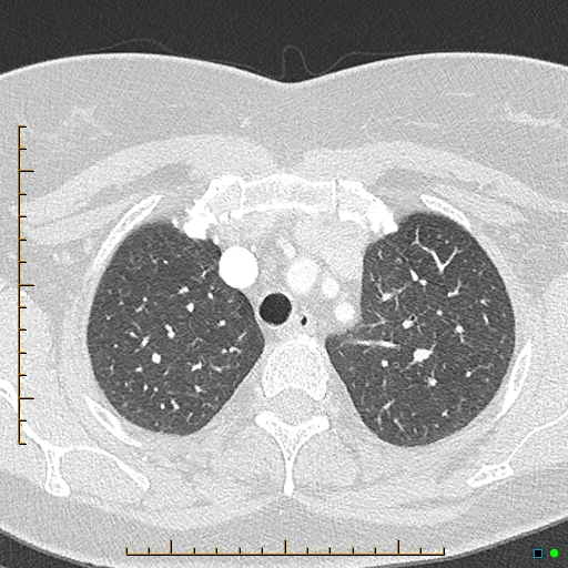 Bronchial diverticula (Radiopaedia 79512-92676 Axial lung window 32).jpg