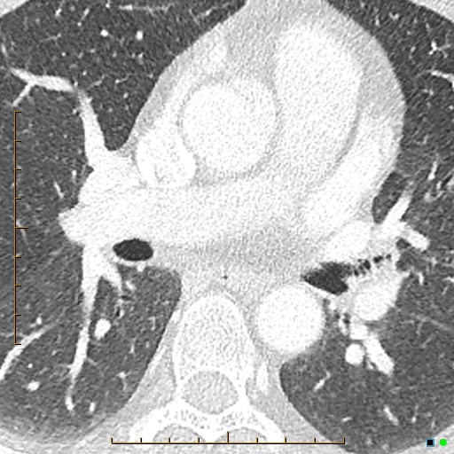 File:Bronchial diverticula (Radiopaedia 79512-92677 Axial lung window 13).jpg