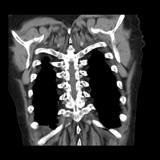 Bronchial stenosis - lung transplant (Radiopaedia 73133-83848 Coronal non-contrast 55).jpg